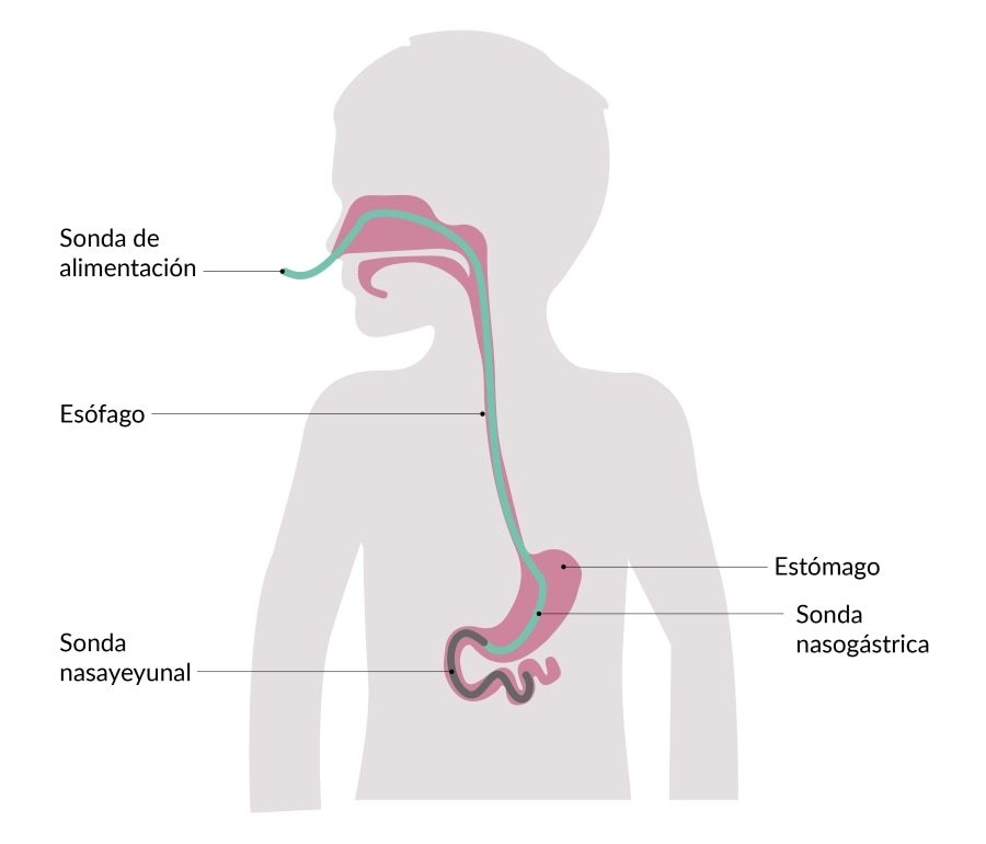 nutricion paralisis
