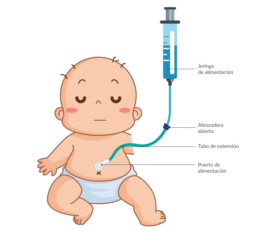nutricion -paralisis